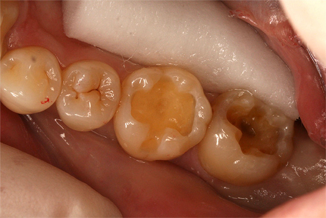 健康な歯質は触らずにむし歯だけを徹底的に除去