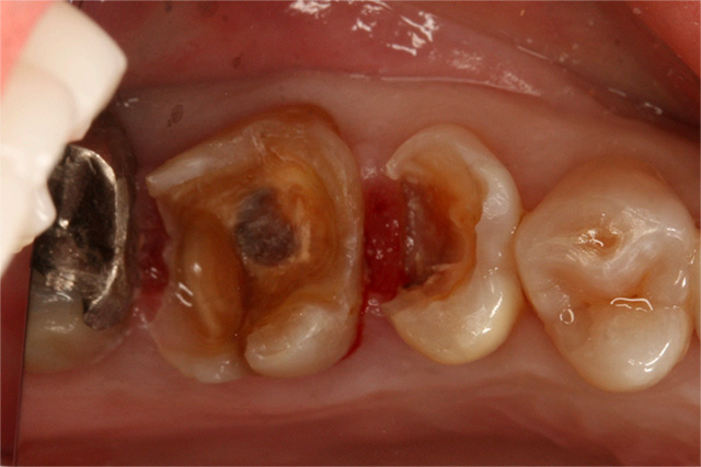むし歯治療と歯周病治療6