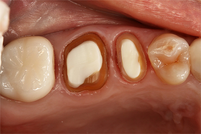 むし歯治療と歯周病治療7