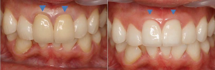 ホームホワイトニングと前歯のセラミック治療