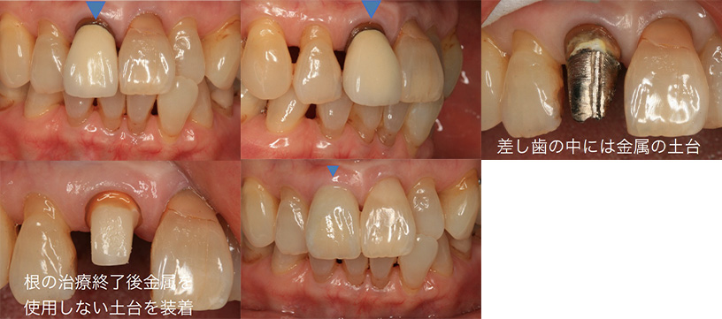 前歯のメタルフリー治療